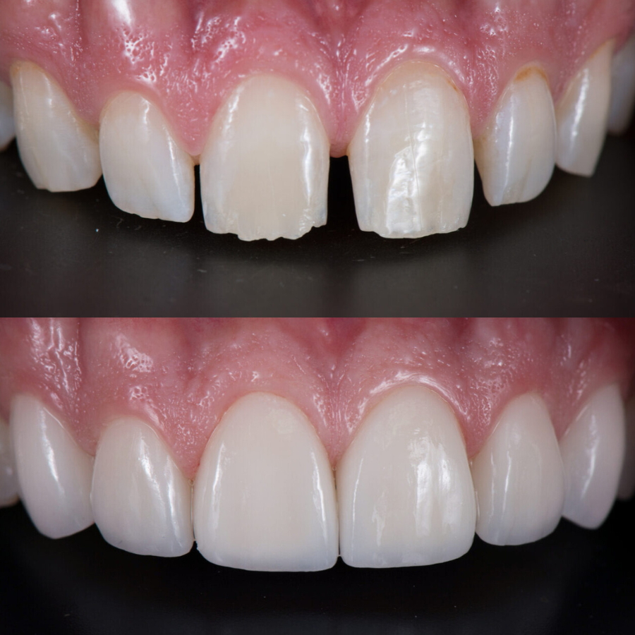 Ästhetik vorher und nachher