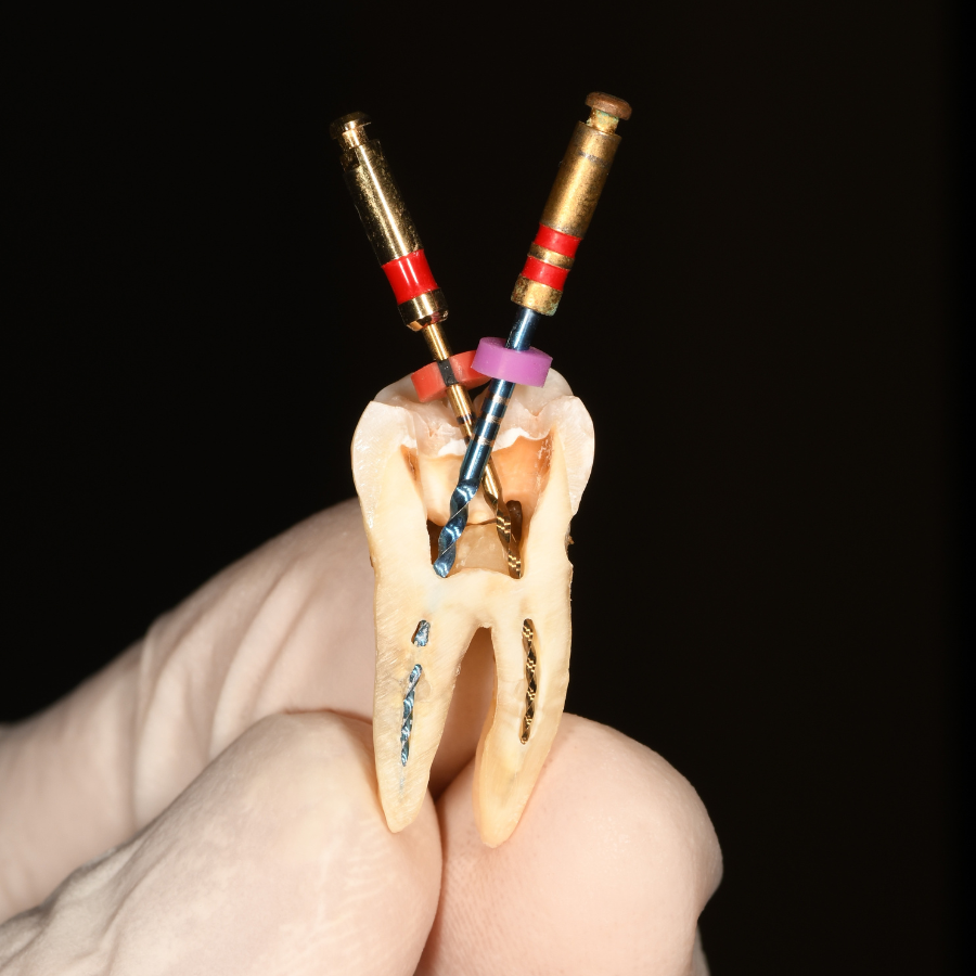 Wurzelfüllung