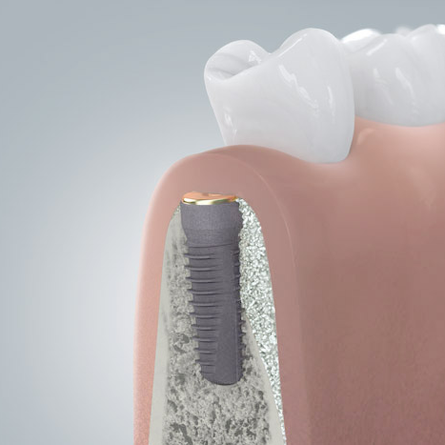 Einheilung des Implantats im Kieferknochen Einheilung des Implantats im Kieferknochen