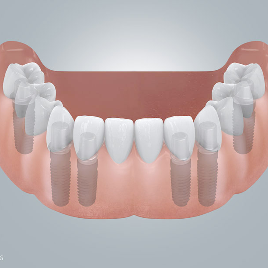 Implantatgetragene Brücke im Unterkiefer – Praxis Dr. Bergschneider Lippstadt